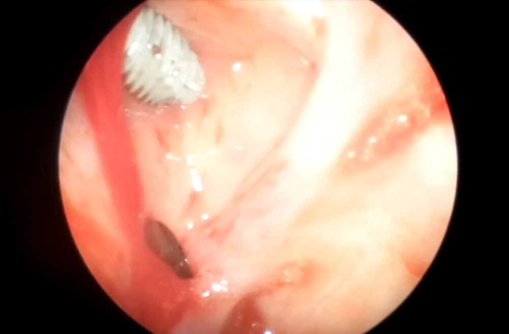 Синусит при установке имплантата Синусит при установленном имплантате