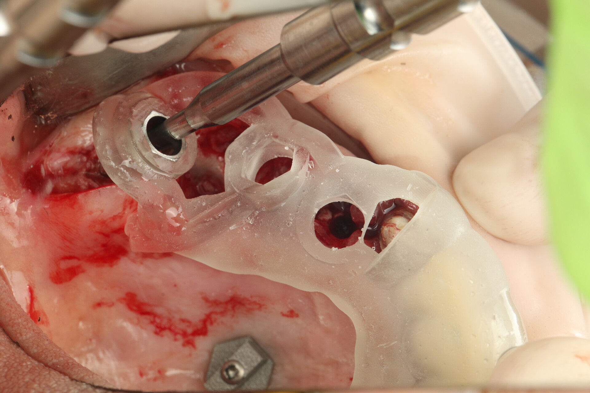 Немедленная нагрузки FP1 при атрофии Протокол немедленной нагрузки FP1 при атрофии