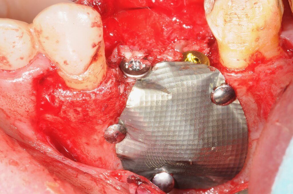 Фиксация кости после наращивания Фиксация кости после наращивания