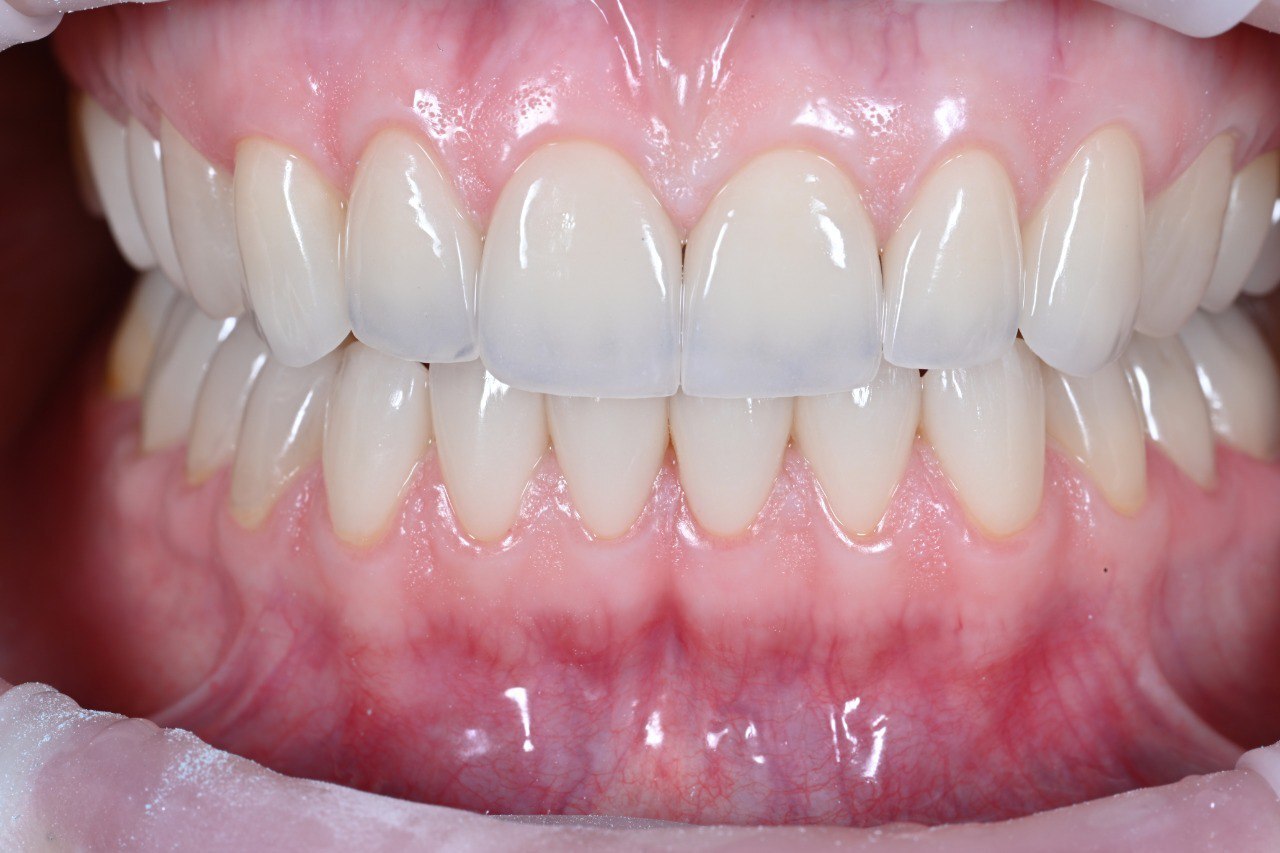 Демонстрация лечения ВНЧС Демонстрация лечения ВНЧС по концепции Славичека