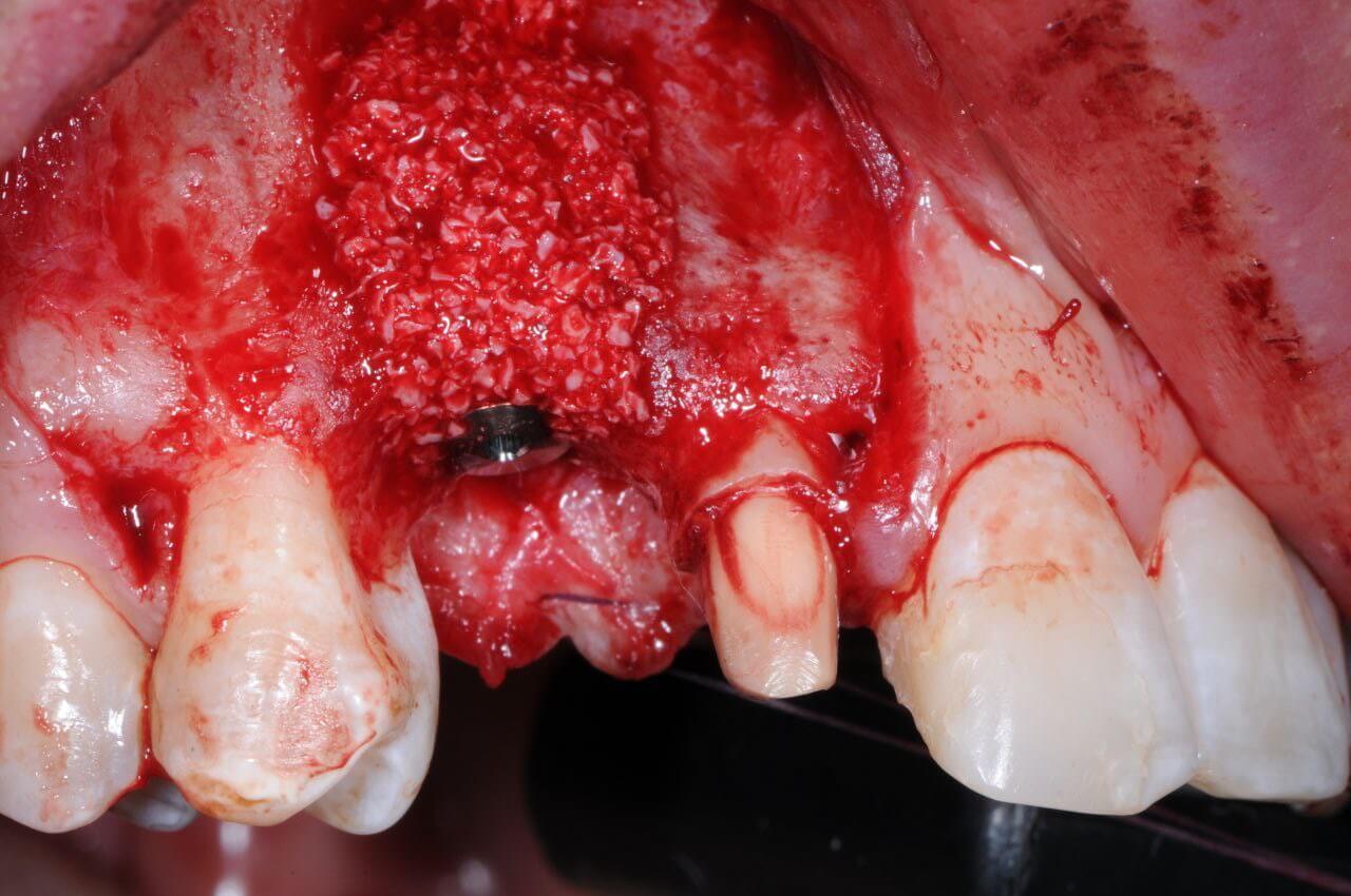 Горизонтальный дефект челюсти Горизонтальный дефект челюсти