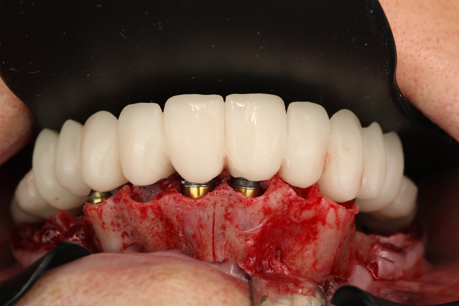Результат протезирования по протоколу FP1. Maxilla-For-All