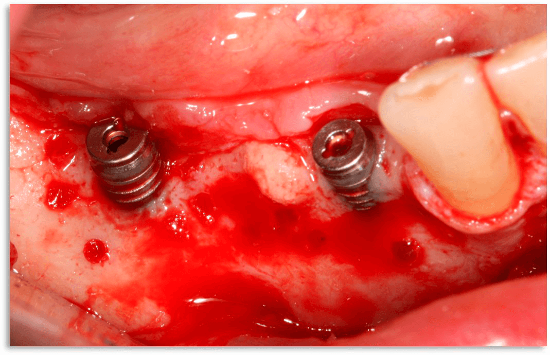 Результат развития переимплантита