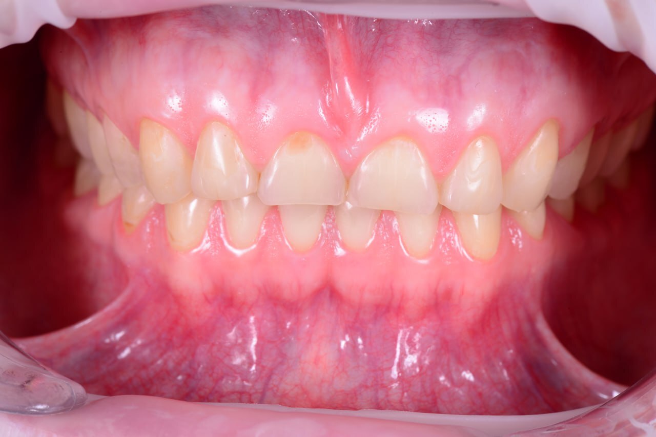 Клинический пример функционального расстройства ВНЧС Клинический пример функционального расстройства ВНЧС