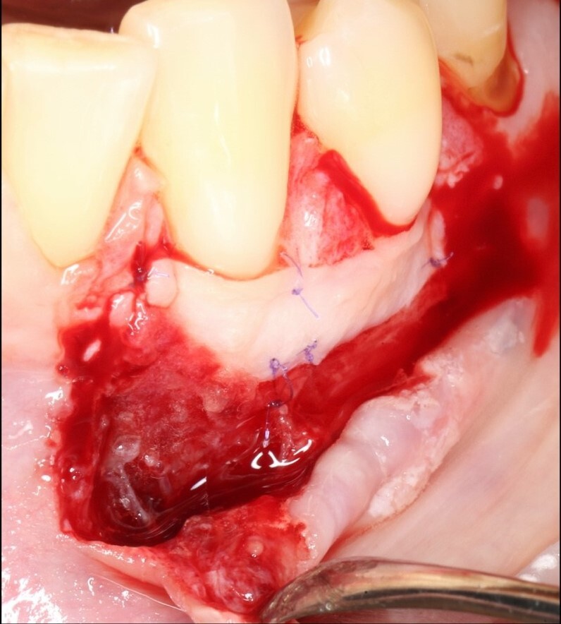 Пластика мягких тканей. Устранение рецессии во фронтальном отделе Пластика мягких тканей. Устранение рецессии во фронтальном отделе