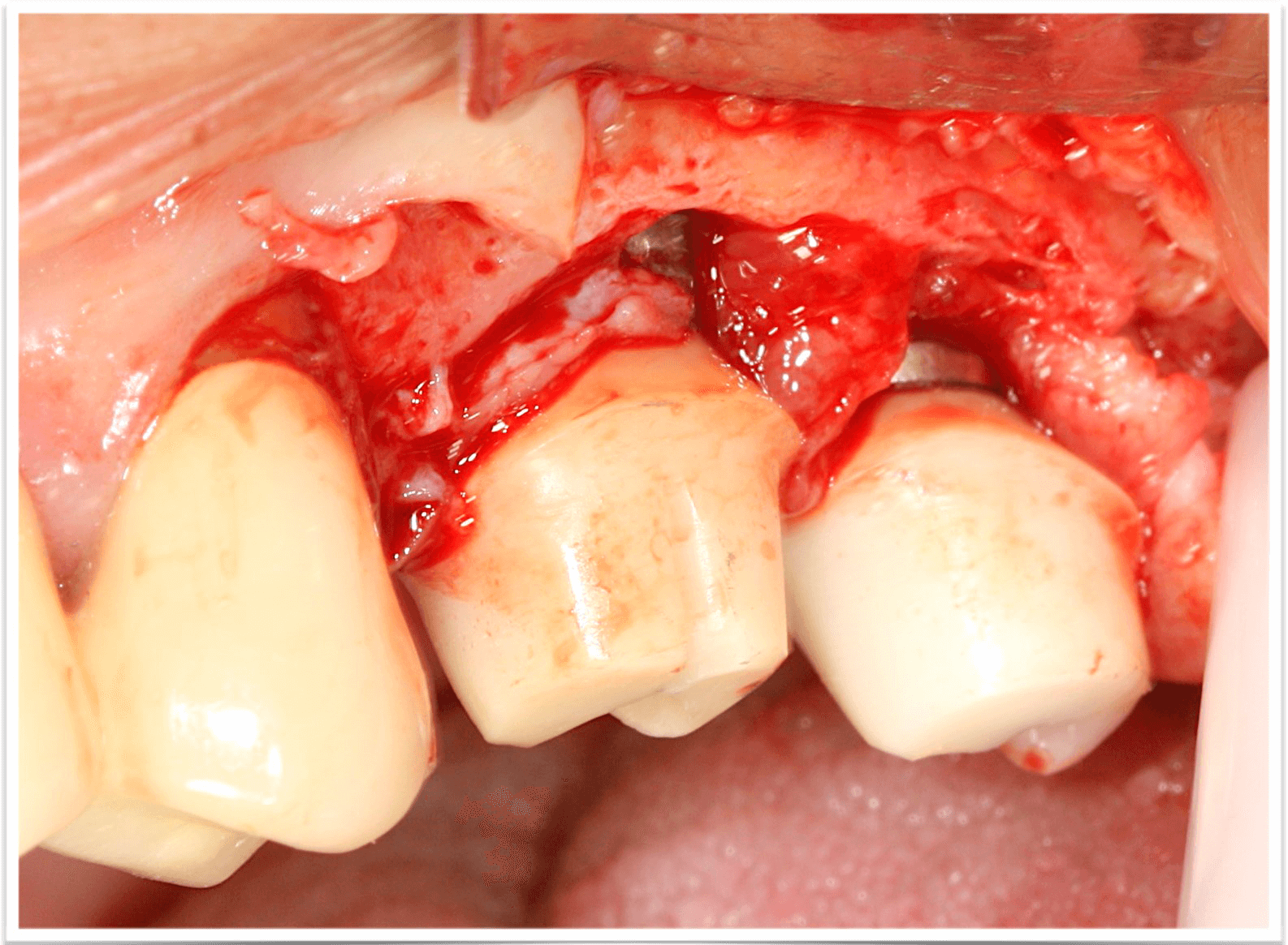 Авшаров. Осложнения при имплантации Авшаров. Осложнения при имплантации