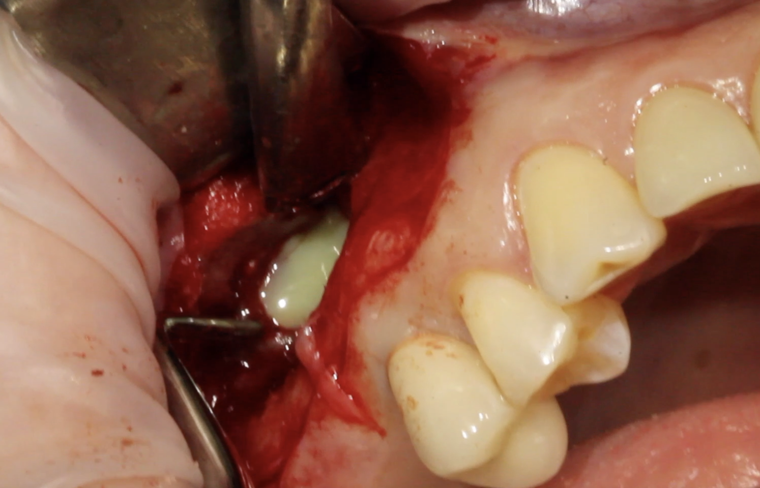 Амбулаторное лечение верхнечелюстного синусита