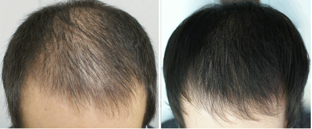Результат мезотерапии волос 