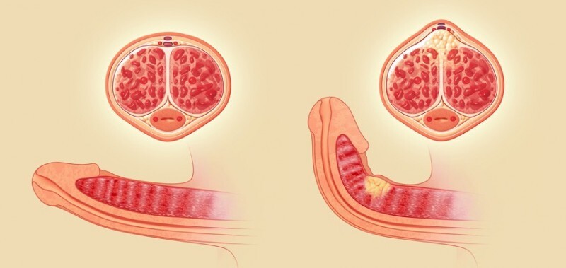 Болезнь Пейрони - причины заболевания, симптомы, стадии развития, диагностика и лечение в Москве