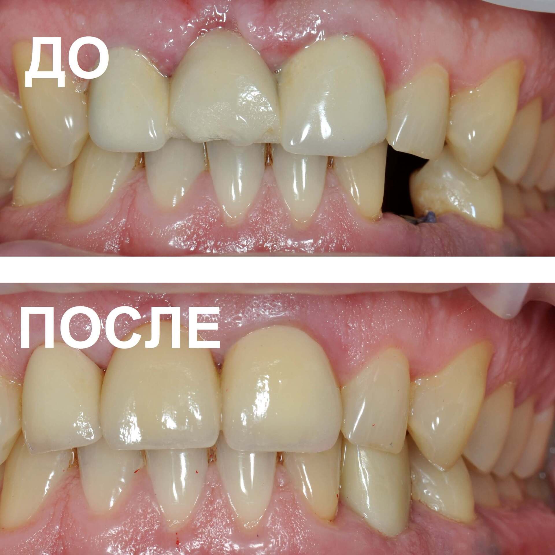 Установка имплантата в стоматологии Подольска