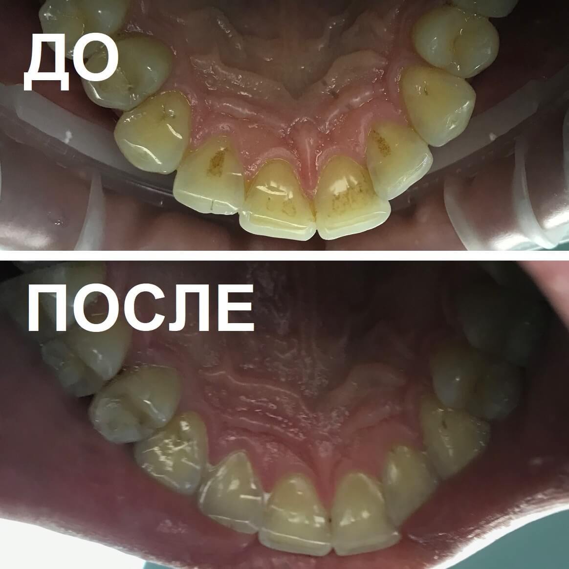 Чистка зубов в стоматологии Подольска