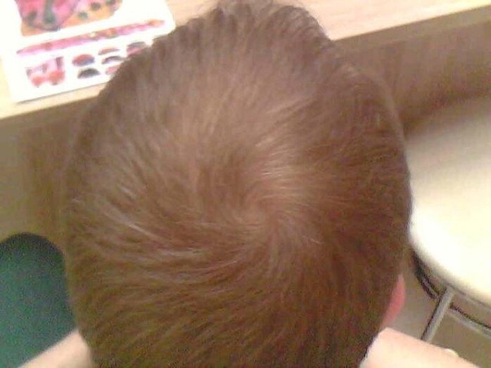 телогенное выпадение волос у мужчины