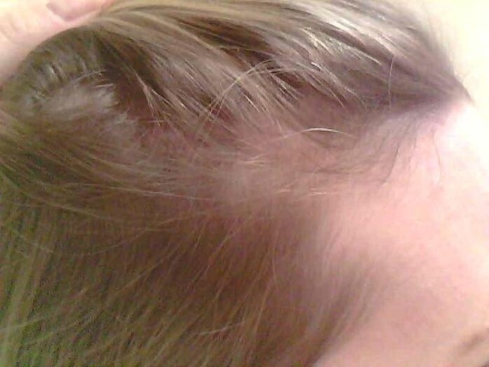 телогенное выпадение волос