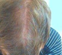 кожа головы после лечения