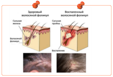 Себорейный дерматит - здоровая и воспалённая луковицы волоса