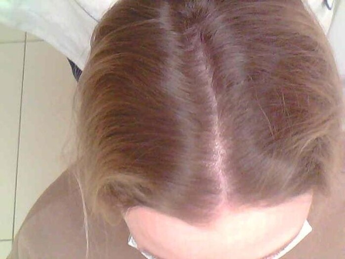телогенное выпадение волос