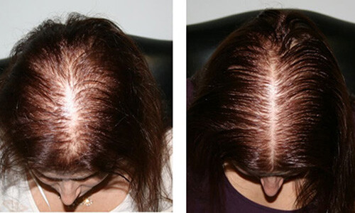 лечение волос после ковида