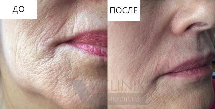 Курасен В Косметологии Цена