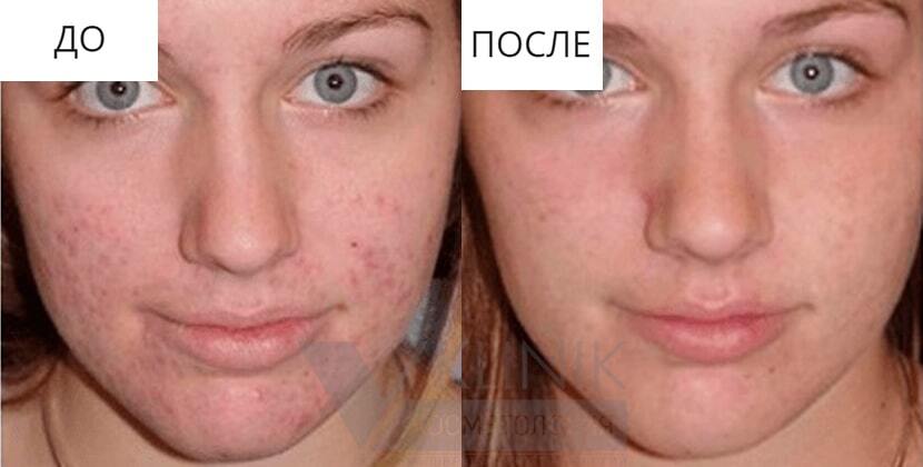 Курасен В Косметологии Цена