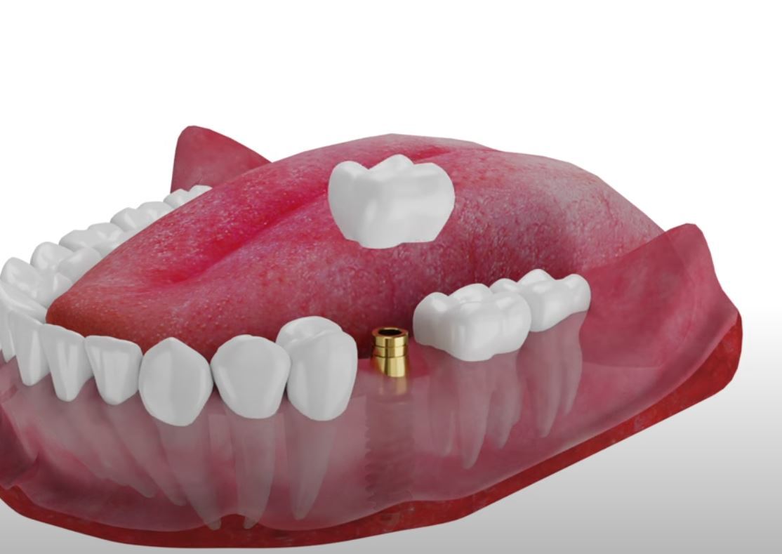 Импланты зубов  в Оренбурге